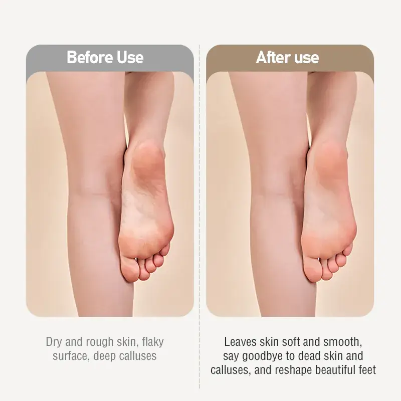 Xiaomi Showsee Electric Foot File Vacuum Callus Remover